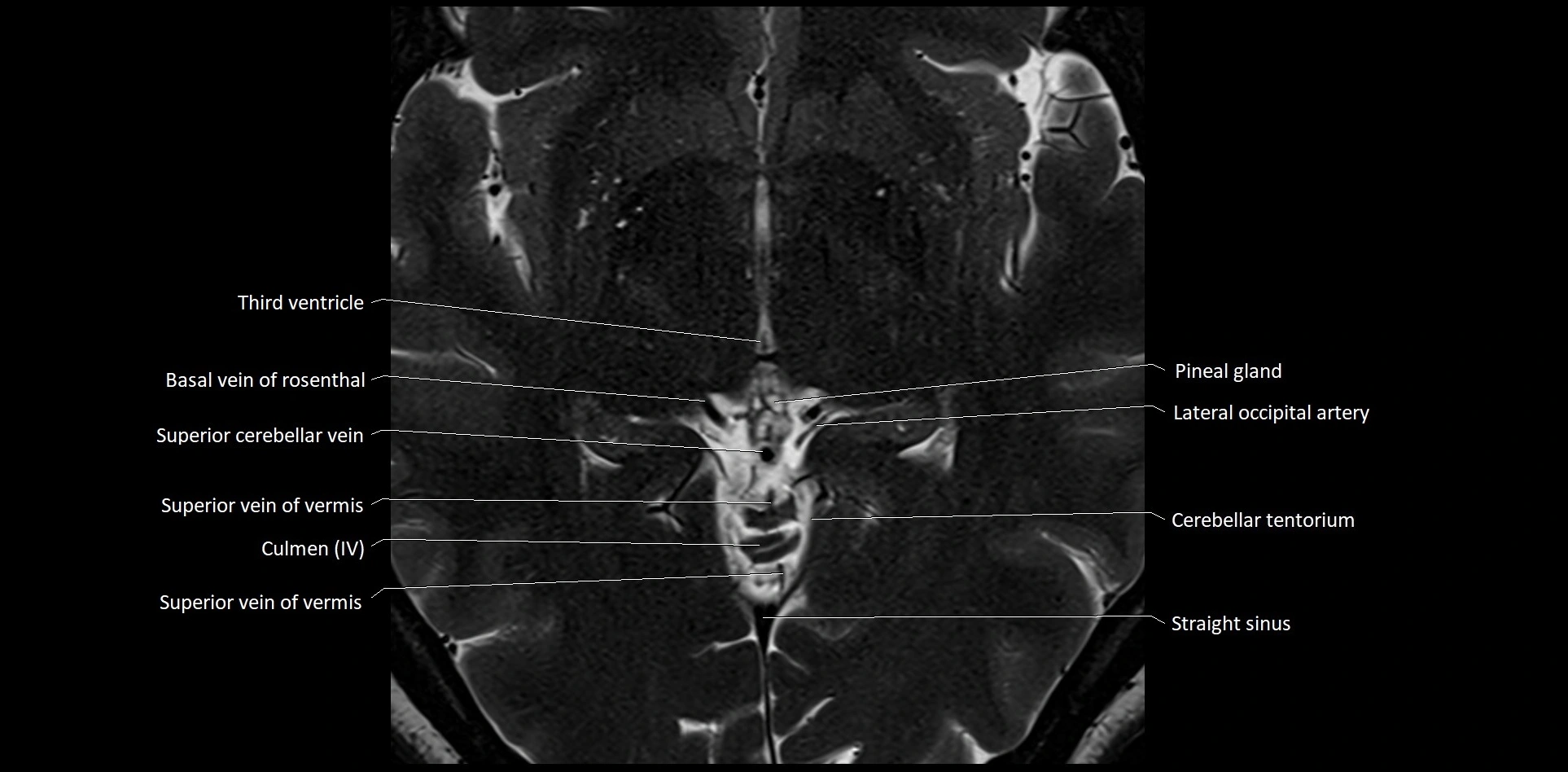 MRI Cerebellar anatomy High-resolution labelled 3T MRI image 29.webp
